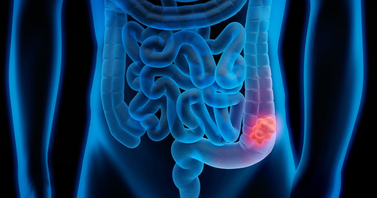 Colon cancer: One in four has a family history – how to recognize your risk
