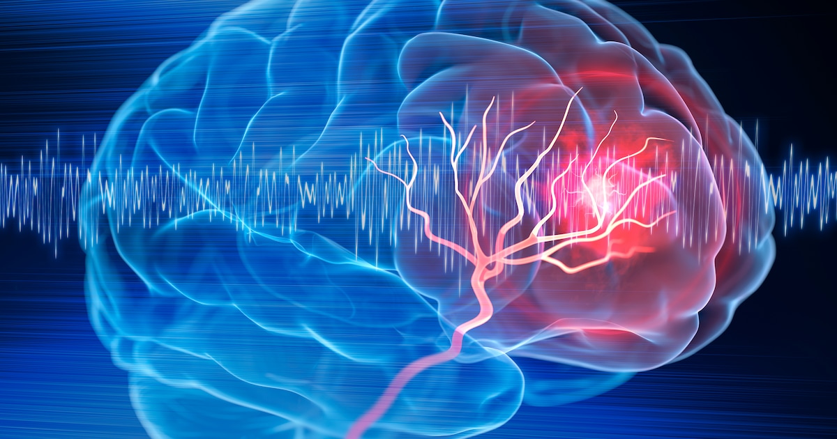 “Mini stroke” often goes unnoticed – five warning signs