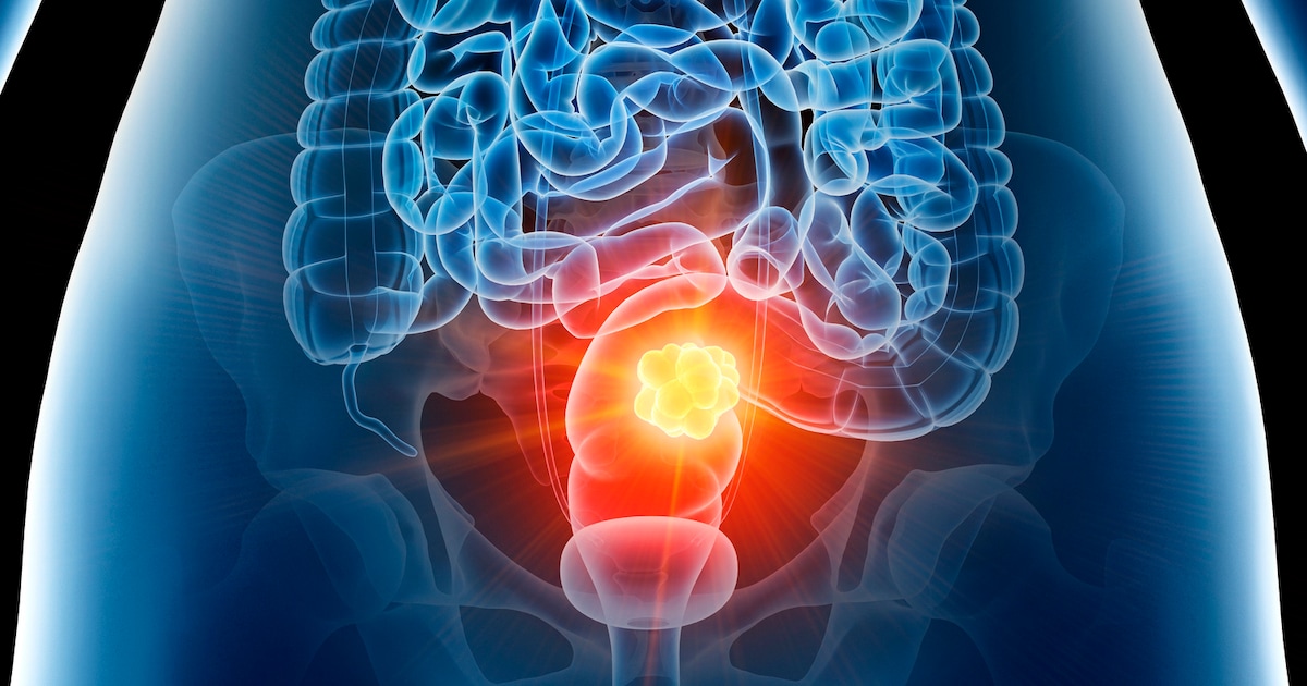 Colon cancer: A doctor pays attention to 2 signals in himself