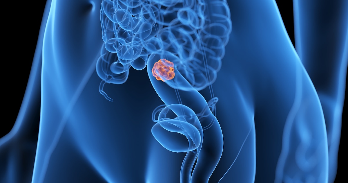 Even if you are under 50, if you have two symptoms you should have a colonoscopy immediately